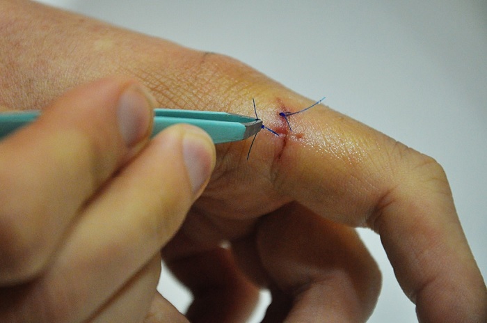 remove stitches