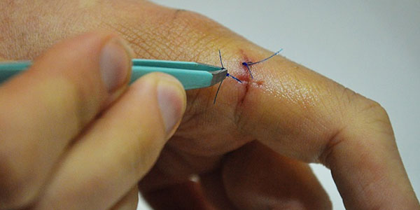 How To Remove Stitches Under Supervision